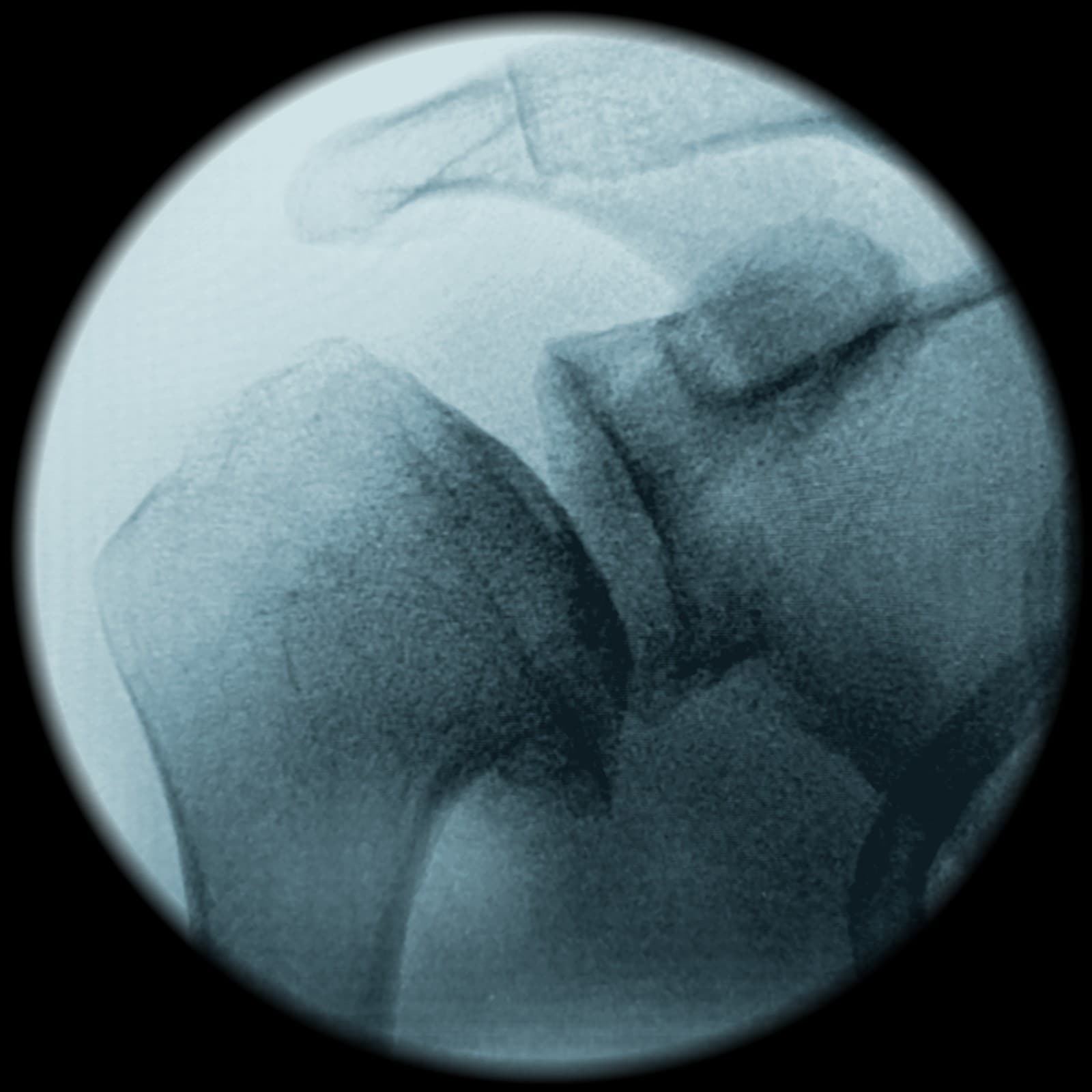 De-identified intra-operative fluoroscopy of an arthritic glenohumeral joint